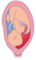 Placenta previa marginal