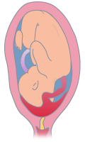 Placenta previa oclusiva total