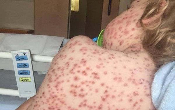 Otra mamá comparte la foto de su hijo con varicela para concientizar sobre la vacunación