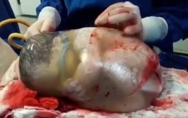 El asombroso video de un bebé que nace dentro de su saco amniótico
