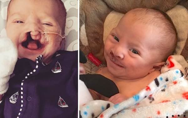 Este bebito tenía labio leporino y así quedó su sonrisa luego de la operación