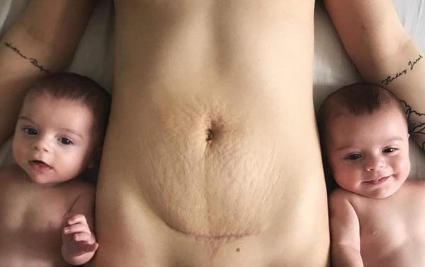 Una mamá comparte la foto de sus estrías y la cicatriz de su cesárea volviéndose viral en Internet